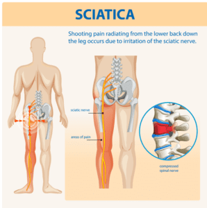 What is Sciatica